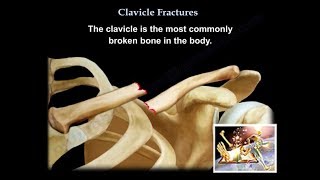 Clavicle Fractures  Everything You Need To Know  Dr Nabil Ebraheim [upl. by Eednahs181]