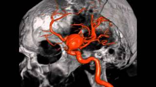 3D aneurysm animationavi [upl. by Rap]