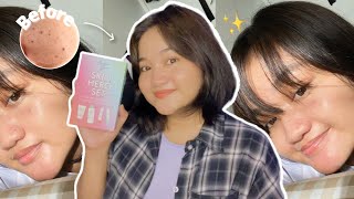 SKIN HERO SET BY CARELINE SKIN✨ 2 WEEKS REVIEW [upl. by Niuqauj]