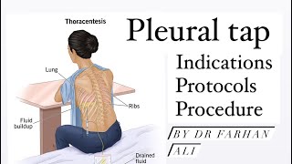 ThoracentesisPleural Tap by Dr Farhan Ali [upl. by Clinton]