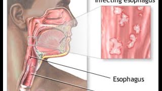 Candida Esophagitis [upl. by Landrum]