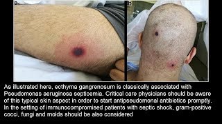 Ecthyma gangrenosum bei Pseudomonas aeruginosa Sepsis [upl. by Asel]