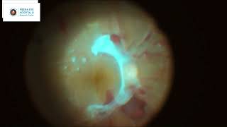 Diabetic Vitrectomy  MEHRC  Dr Ashish K Jain [upl. by Egan]