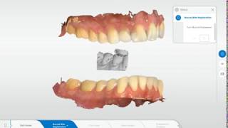 How to do a manual bite correlation in Connect software [upl. by Nelac]