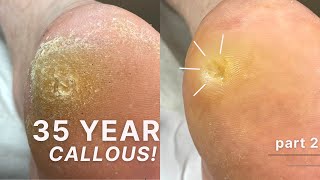 35 YEAR OLD CALLOUS 😱 Removing Callouses amp Super Deep Corns PART 2 [upl. by Esyned]