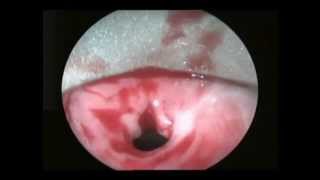 Stricture oesophagus in a 2 yr old  BALLOON DILATATION WITH MITOMYCIN APPLICATION [upl. by Nonnahs]