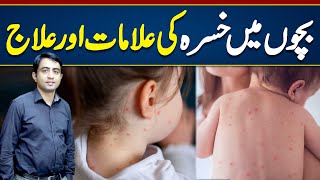 Measles Symptoms amp Treatment  Measles Treatment For Babies  Khasra Ki alamat Aur ilaj [upl. by Yelknirb]