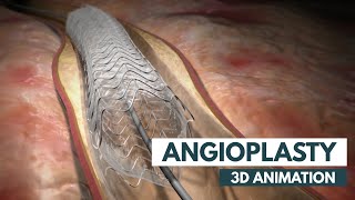 Angioplasty  3D Animation  Real Footage [upl. by Aredna]