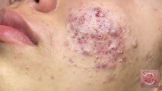 Inflammatory acne is a type of skin acne that often comes with swelling redness and pus [upl. by Erdnaed]