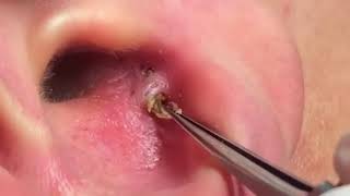 One blackhead with 56 holes [upl. by Sabba]