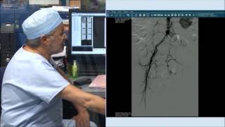 24 common right iliac stenting recanalisation of external left iliac incathlabcom [upl. by Rheingold278]