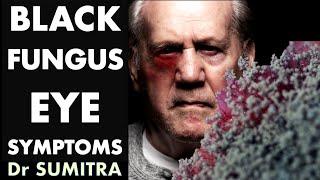 Black Fungal infection  EYE symptoms of Mucormycosis  Dr Sumitra [upl. by Rabkin]