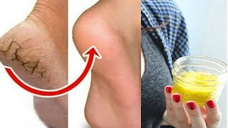 रातों रात फटी एड़ियां से छुटकारा पाये  इस उपाय से पैर भी हो जाएंगे गोरे  Cracked Heels Home Remedy [upl. by Hittel]