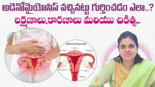 What is Adenomyosis  What are the Symptoms for Adenomysis  Best Avni Fertility Andrology [upl. by Sonnie]