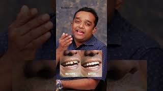 അര മണിക്കൂറിൽ പല്ല് ശെരിയാക്കാം dentalclinic dentaltips dentalcrowns dentalveneers smile [upl. by Shandra]