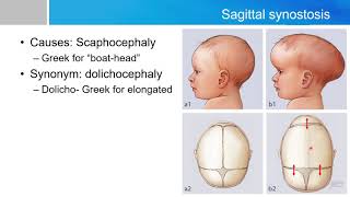 Neurosurgery written board crash course  craniosynostosis part1 [upl. by Majka]