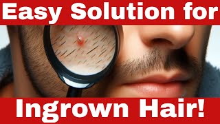 How to Get Rid of Ingrown Hair FAST and Safely at Home [upl. by Rorrys]