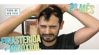 Finasterida e Minoxidil  2 meses  Primeiros Resultados  PARA DE SER FEIA [upl. by Nigrom702]