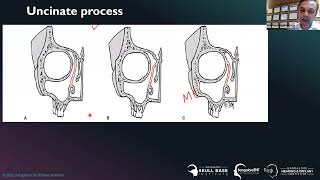 Webinar  Endoscopic Anatomy of Sinonasal and Anterior Skull Base  BEIRC [upl. by Foulk]