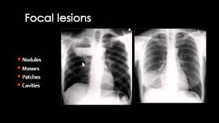 Chest XRay CXR in Arabic  Prof Mamdouh Mahfouz [upl. by Eziechiele]