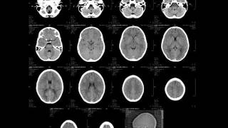 Radiology  Normal brain anatomy  CT and MRI [upl. by Riay]