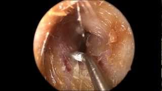 Ear Wax Cerumen Removal in HD [upl. by Pettit]