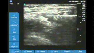 Ultrasound Guided Femoral nerve block [upl. by Bilek225]