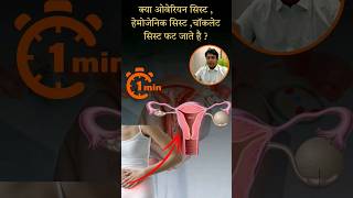 क्या ovarian cyst  hemorrhagic cyst और chocolate cyst फट जाते है  cyst treatment wellness [upl. by Redna908]