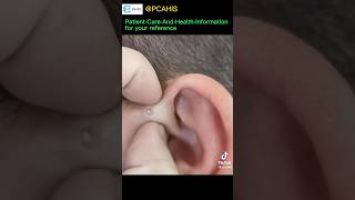 Earpit preauricular pit squeezing pimplepopping earwaxclinic acnepatch pimplelife acnetreatment [upl. by Trout50]