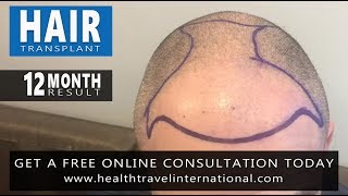 FUE Hair Transplant  12 Month Result  Hairline Restoration  Hair Loss Before amp After [upl. by Aro]