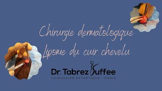 Chirurgie dermatologique  Lipome du cuir chevelu [upl. by Savick222]