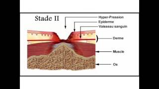 Soins des escarres en gériatrie  2Physiopathologie de lescarre [upl. by Leaj]