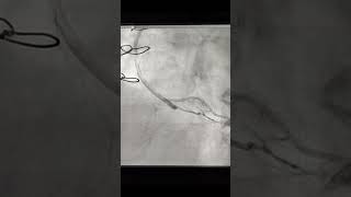 SVG PDA graft with thrombus in post CABG [upl. by Sofie]