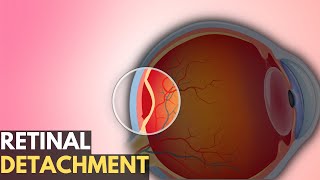 Retinal Detachment Everything You Need To Know [upl. by Aiduan]