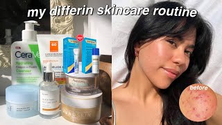 DIFFERIN GEL Review1st week update adapalene gel for acne and hyperpigmentation differingel [upl. by Sanyu]