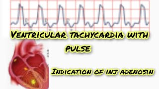 ventricular tachycardia with pulse [upl. by Assirk612]