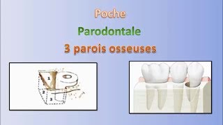 Les poches en parodontologie  Pocket in periodontology [upl. by Sudnak]