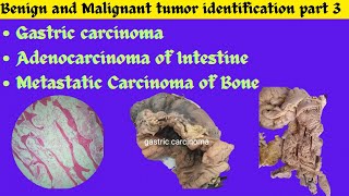 Gastric carcinoma Adenocarcinoma of Intestine Metastatic tumor of Bone identification Patho OSPE [upl. by Woodring]