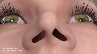 Pinched Narrow Nose Rhinoplasty to Address Nasal Obstruction [upl. by Rihana]