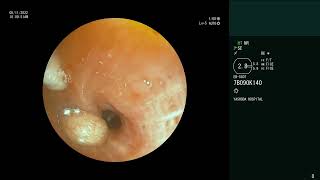 Endobronchial Carcinoid  Tumor debulking  Electrosurgical snaring  Cryoextraction [upl. by Zetra126]