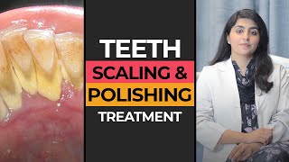 Teeth Scaling amp Polishing in Karachi  HASH DENTAL CLINIC [upl. by Adrien8]