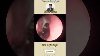 귀지형 콧물 부비동염 축농증 비염 코청소 이비인후과 rhinorrhea rhinitis sinusitis asmr ENT entdoctor [upl. by Ymmac848]