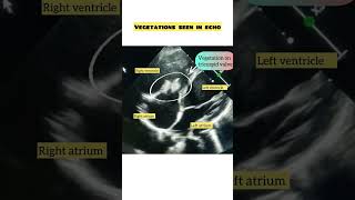 Tricuspid valve vegetation  infective endocarditis heartvalve cardiology echo [upl. by Aserehtairam657]