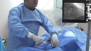 ARES  Angioplastie coronariana cu stent bioresorbabil Absorb  Dr Roberto Haret [upl. by Oiramal]