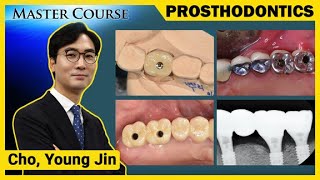 Master Course Season2 PROSTHODONTICS Design of Posterior Implant Prosthesis [upl. by Eyma]