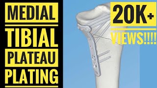 Medial Approach and Plating of Medial Tibial Condyle [upl. by Joey88]