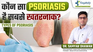 Psoriasis कितने तरह के होते हैं कैसे होगा इनका इलाज  Psoriasis Treatment India [upl. by Maxy953]