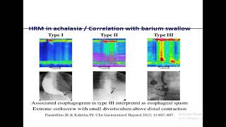 Esophageal Motility Disorders  By Dr Mohamed Abdelhady [upl. by Wind]