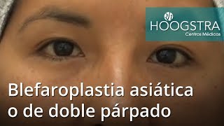 Blefaroplastia asiática o de doble párpado 19009 [upl. by Oler697]