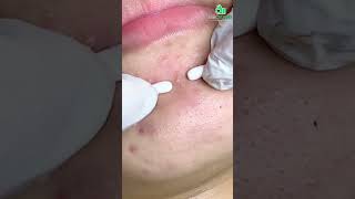 Blackhead Popping Experience Eliminate Impurities at the Root [upl. by Nosak]